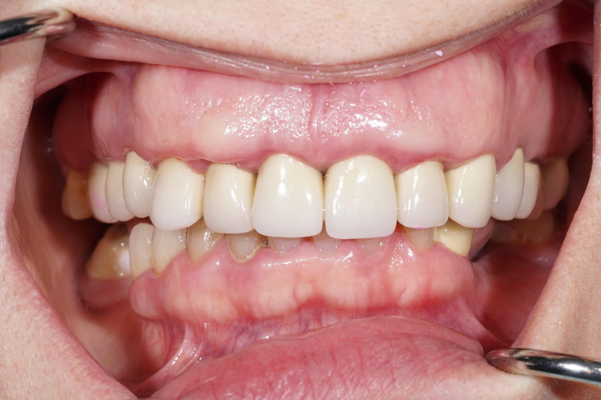 Complex Prosthetic Reconstruction On Teeth And Zirconia Implants