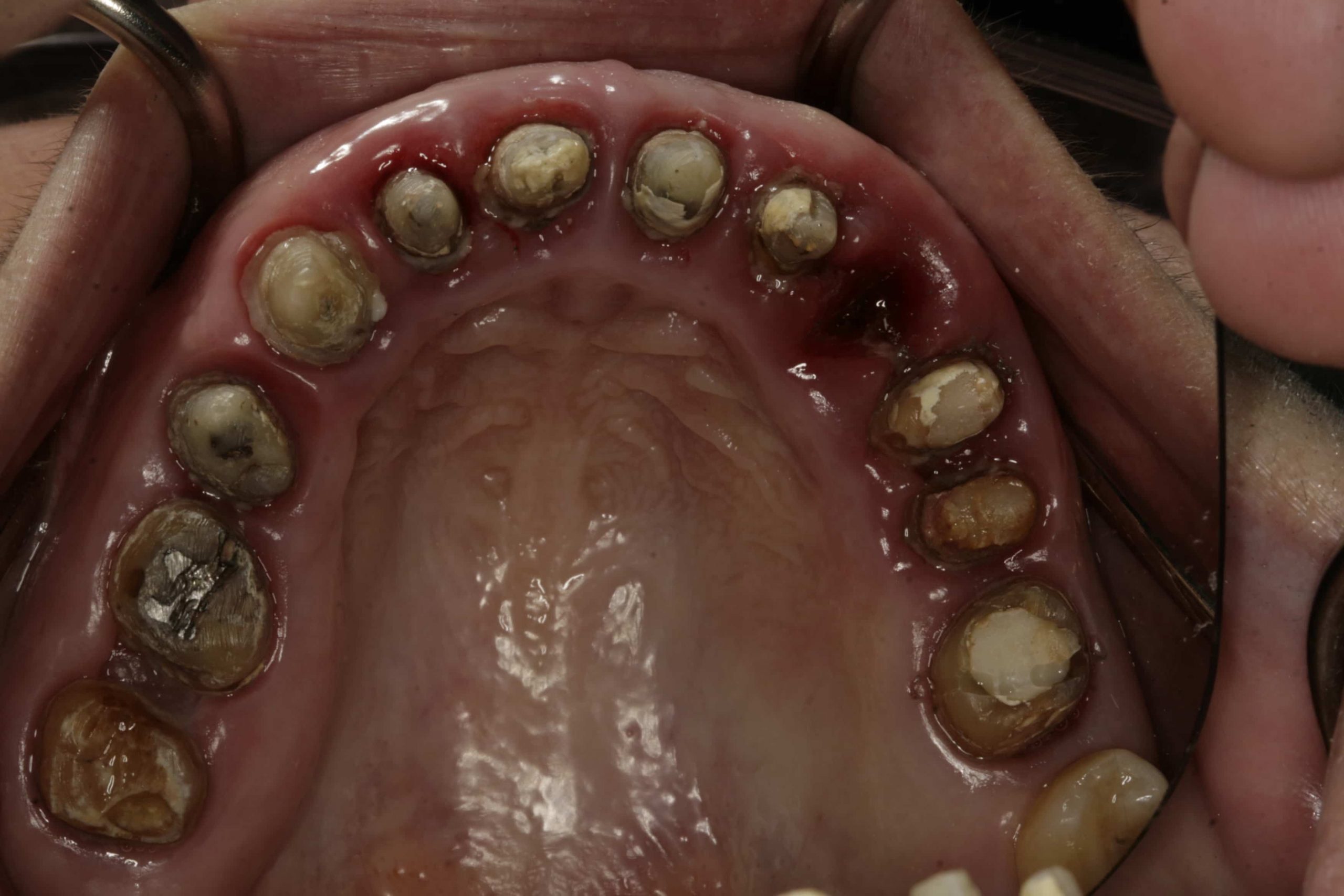 Complex Prosthetic Reconstruction On Teeth And Zirconia Implants