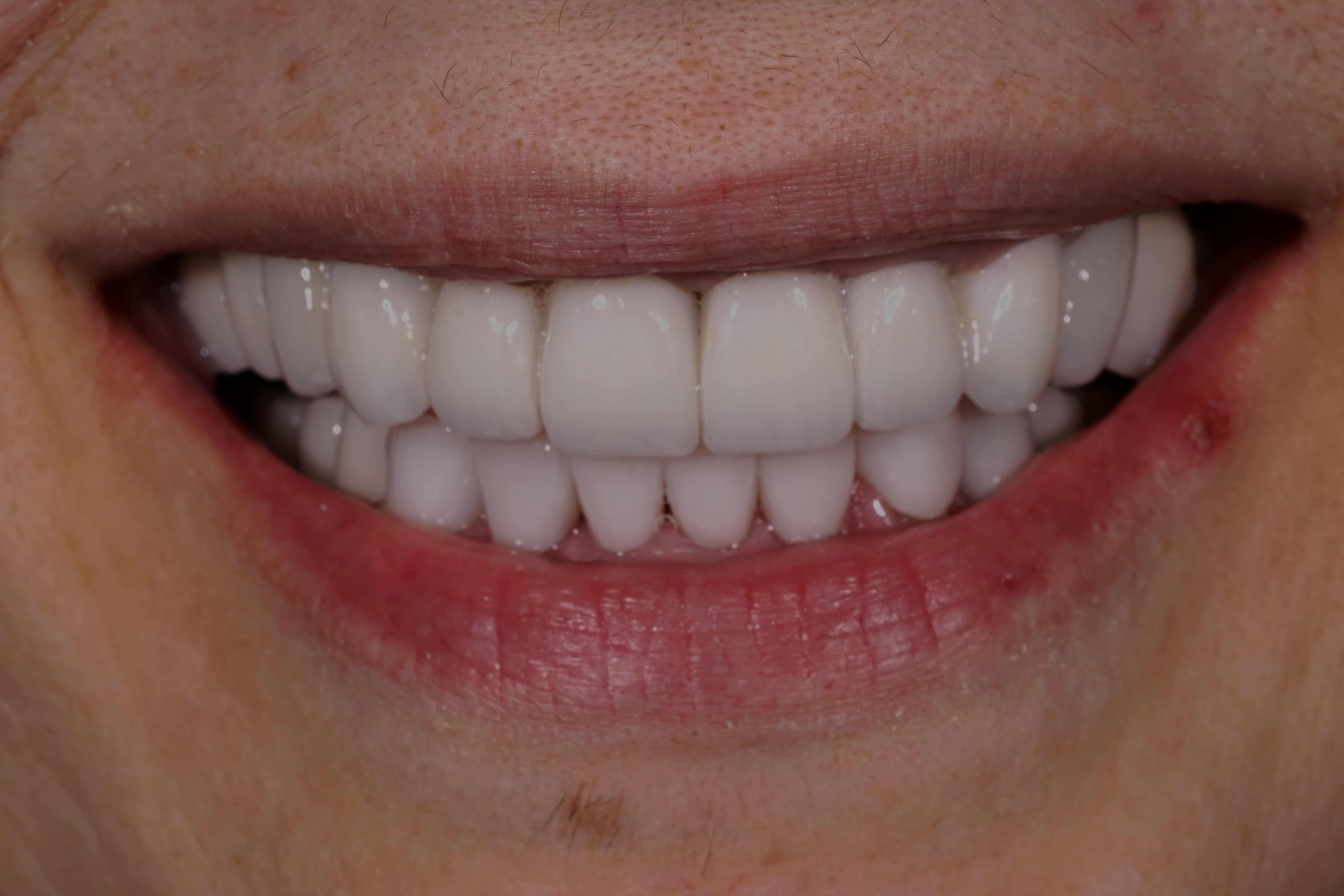 Complex Prosthetic Reconstruction On Teeth And Zirconia Implants ...