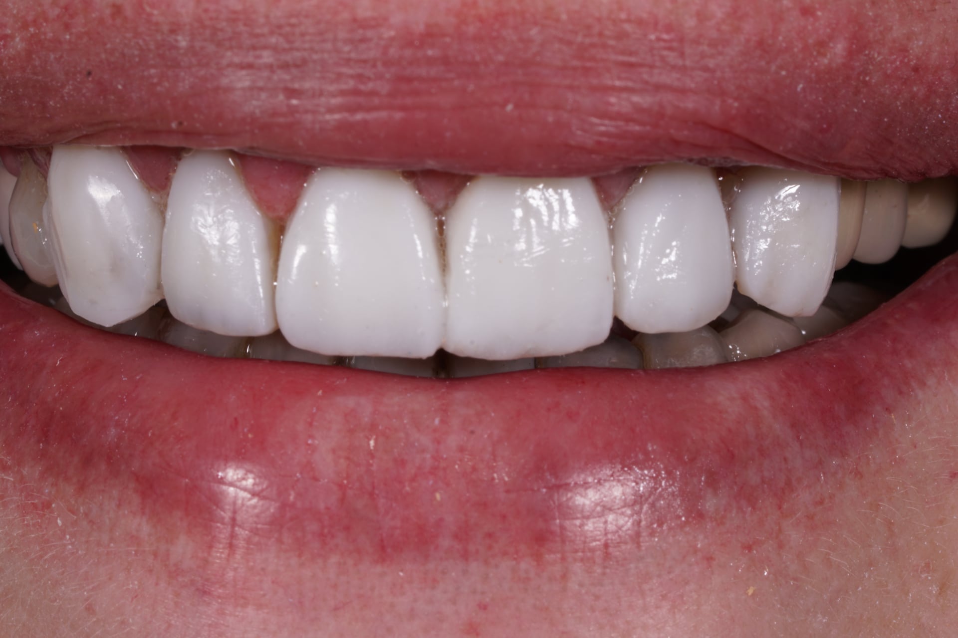 Composite veneers to lengthen front teeth Dental Aesthetics