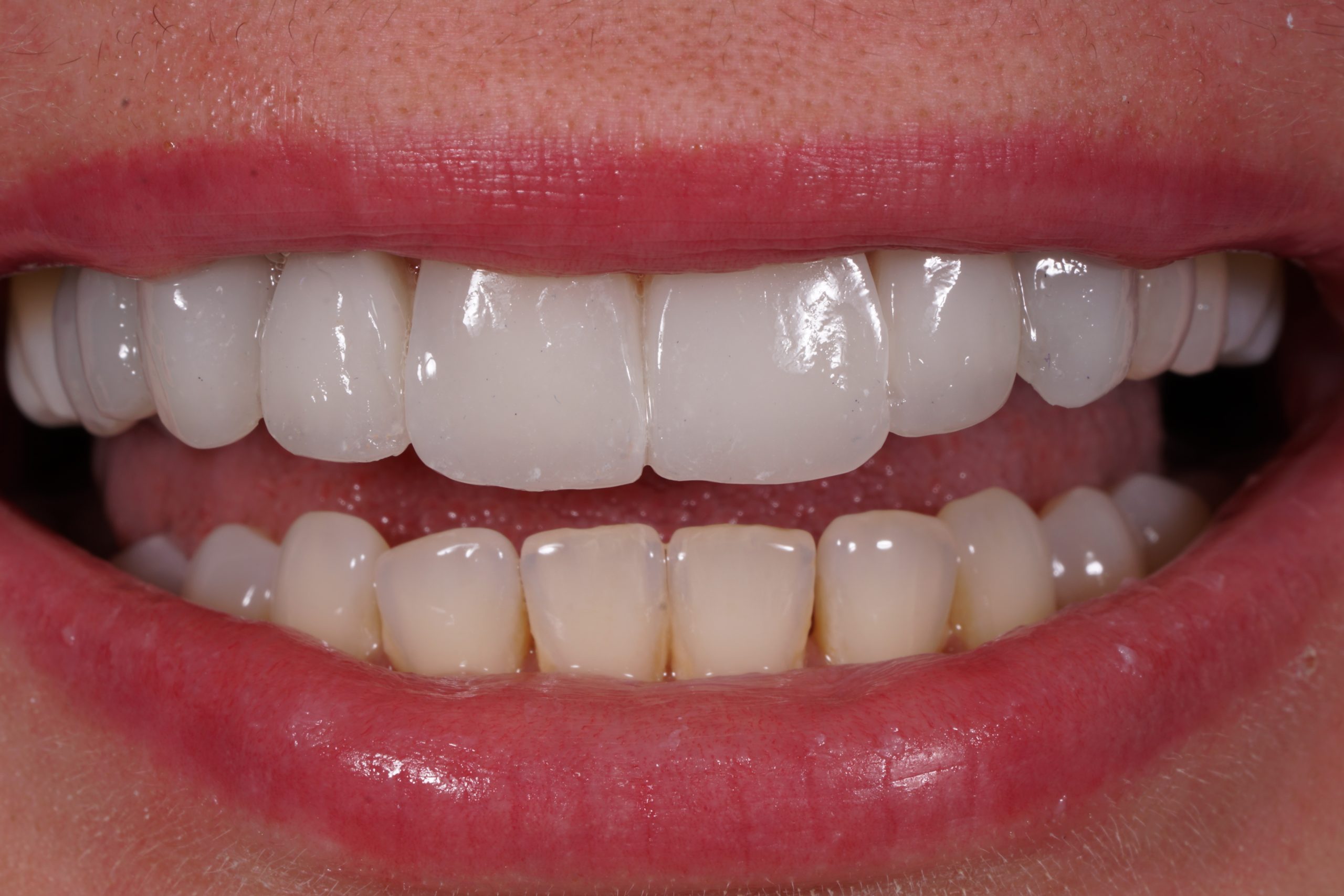 Composite Veneers Fast & Costeffective Smile Upgrade Dental Aesthetics