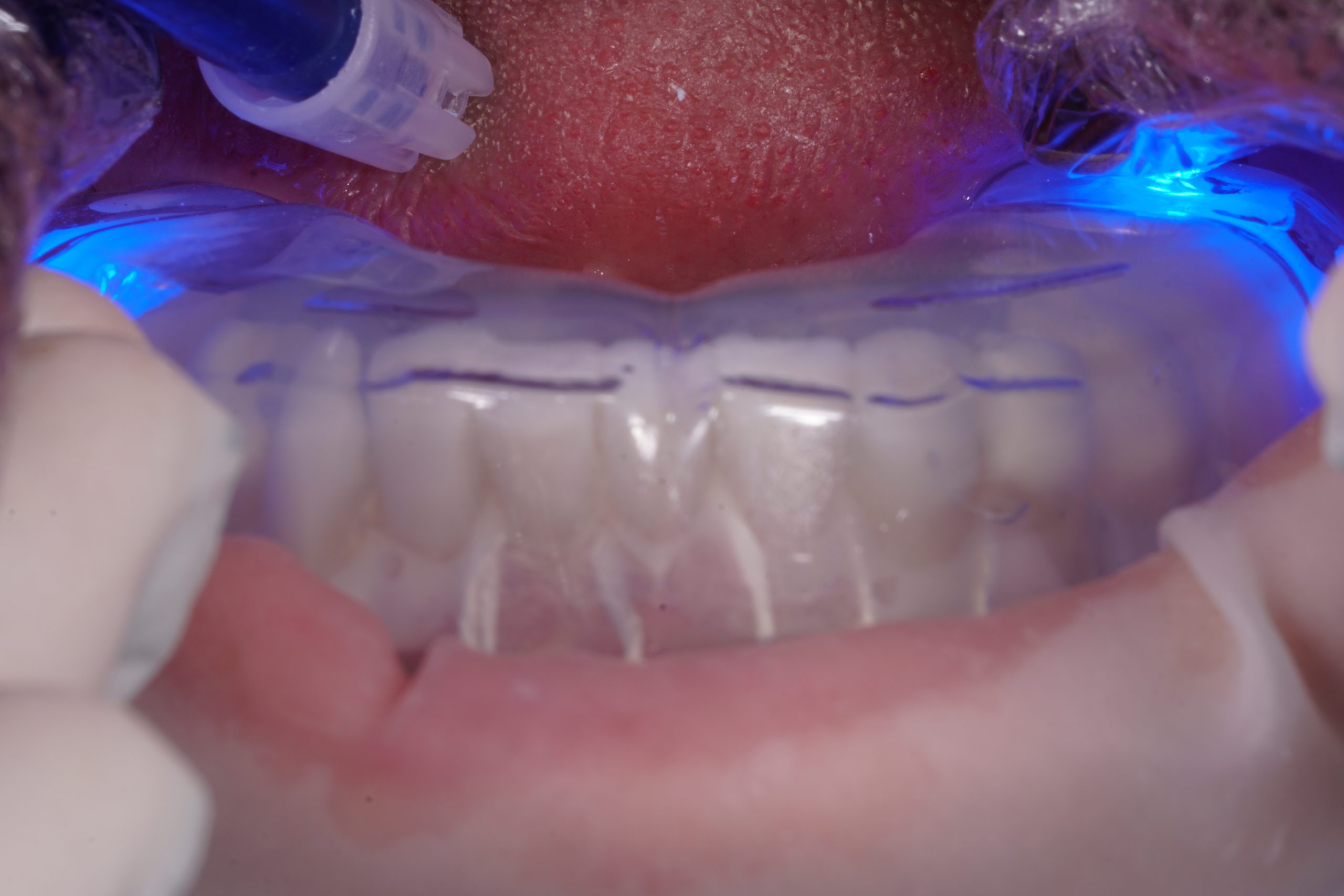 impressive-one-day-makeover-with-bonded-composites-dental-aesthetics