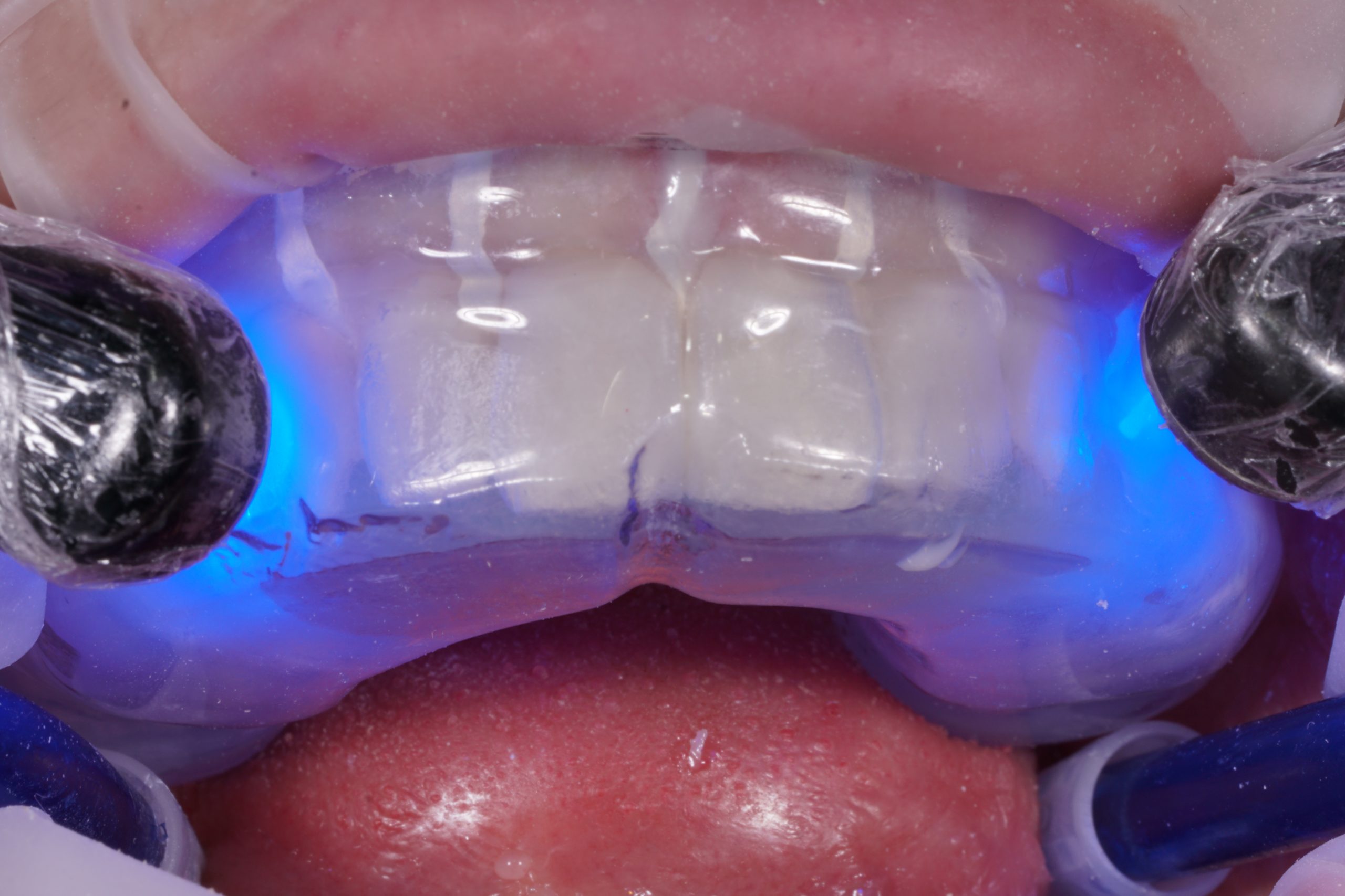 impressive-one-day-makeover-with-bonded-composites-dental-aesthetics